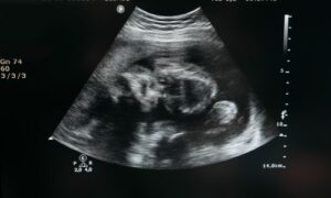 sanjati ultrazvuk sanjati ultrazvuk